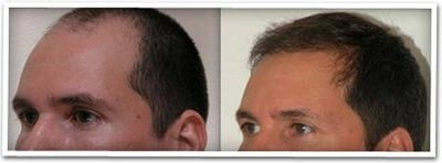 Hair Restoration Orlando FL