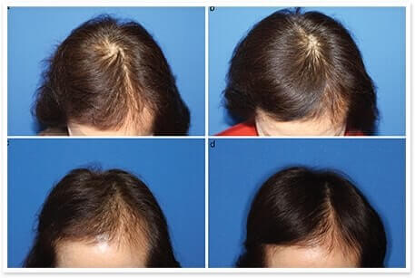 Laser Cap Hair Restoration Therapy Orlando FL | Asim Medical