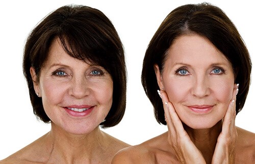 Non-surgical Facelift Orlando FL