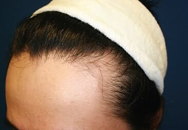 Platelet Rich Plasma Hair Restoration Before Treatment