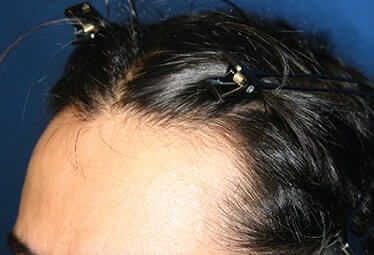 Platelet Rich Plasma Hair Restoration After Treatment